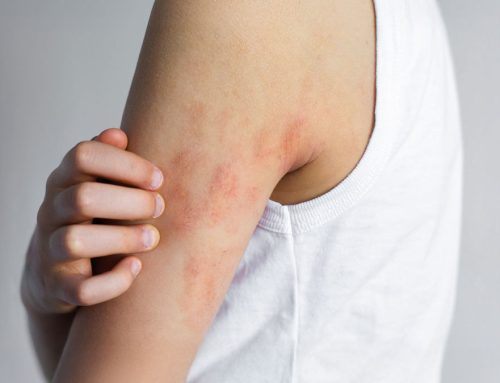 Pele irritada no verão: Como prevenir e aliviar